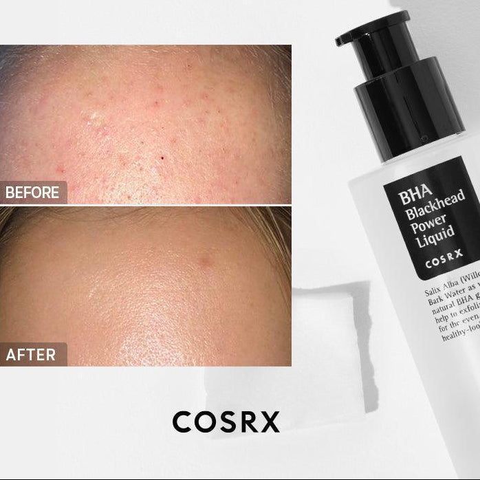 Before and after results of COSRX BHA Blackhead Power Liquid showing reduced blackheads, smoother texture, and clearer pores